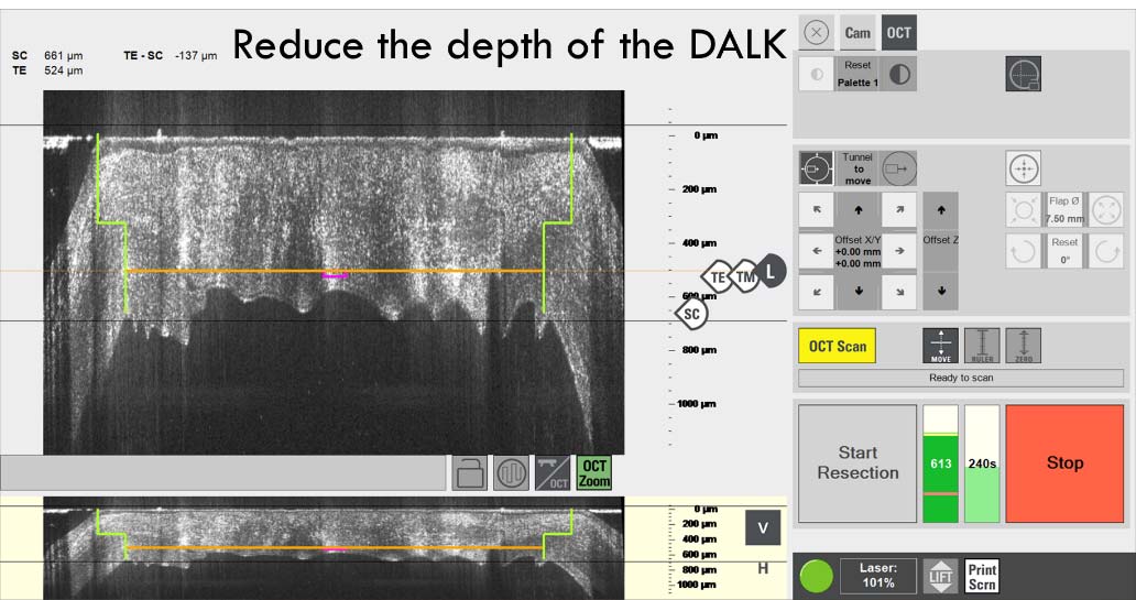 Corneal transplant laser geometry