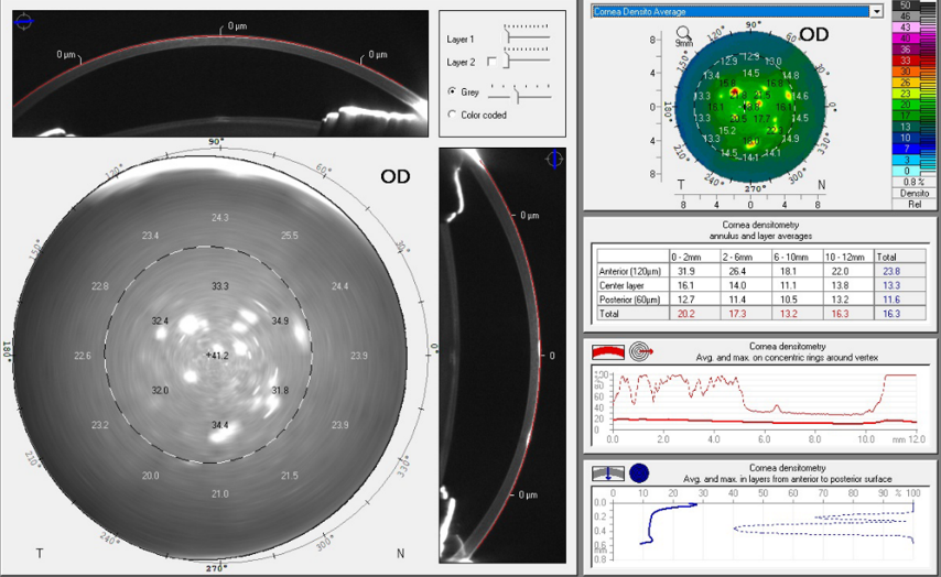 Figure 1 adenoviral keratitis