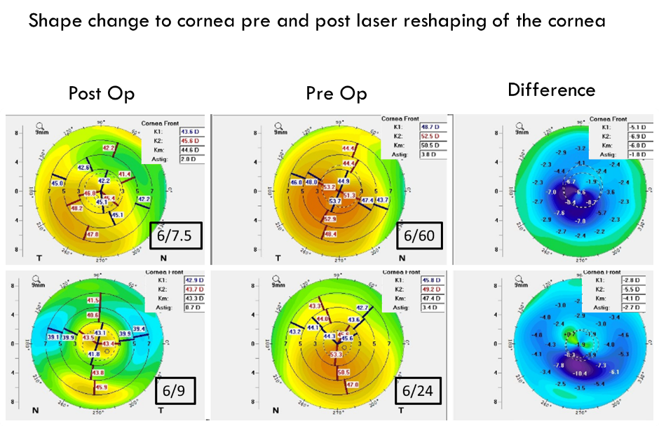 Keratoconus topography before and after