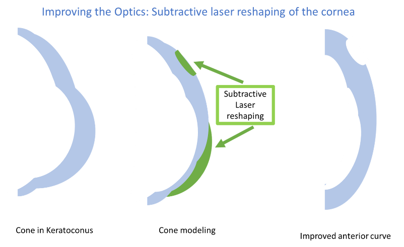 Laser reshaping diagram